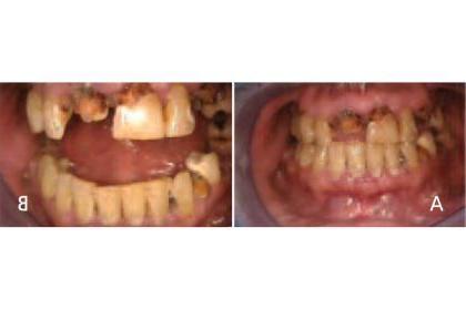 Oral manifestations in the advanced states of methamphetamine abuse include A) teeth broken off at the gingival margin; and B) grayish-brown dentition with enamel that is reduced to a soft leathery texture, 还有牙龈炎和急性牙周炎.